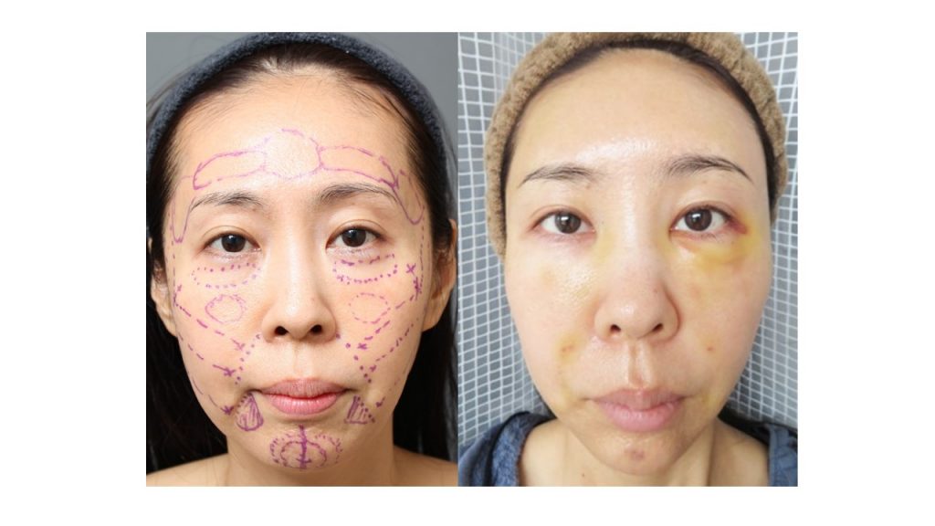 経過（術後5日）46歳女性 顔の若返り施術｜エイジング治療ブログ