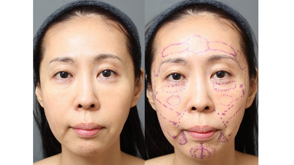 46歳女性 顔の若返り施術の経過（術後1か月）｜エイジング治療ブログ