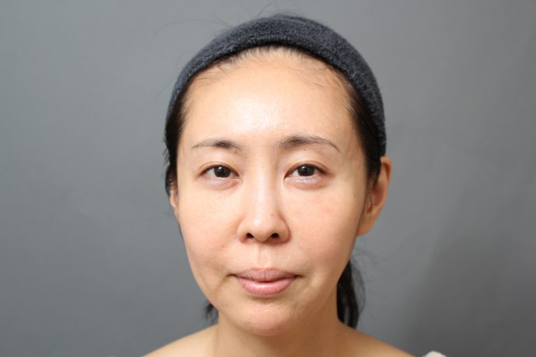 46歳女性 顔の若返り施術の経過（術後1か月）｜エイジング治療ブログ